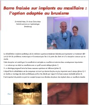 Barre fraisée sur implants au maxillaire : l’option adaptée au bruxisme